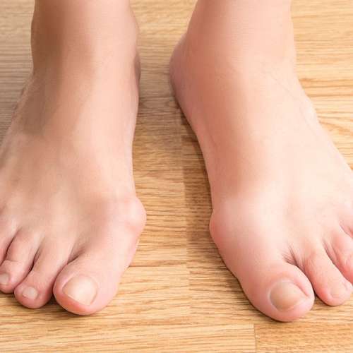 Managing Arthritis in Your Feet