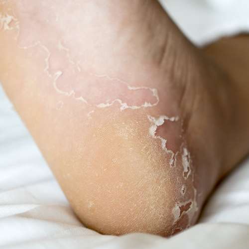 Dealing with Foot Fungus: Prevention and Treatment